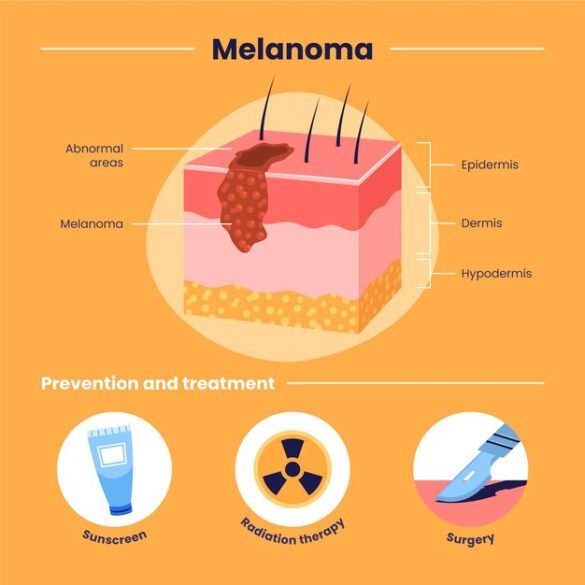 Melanonychia vs Melanoma Explained: The Great Nail Debate